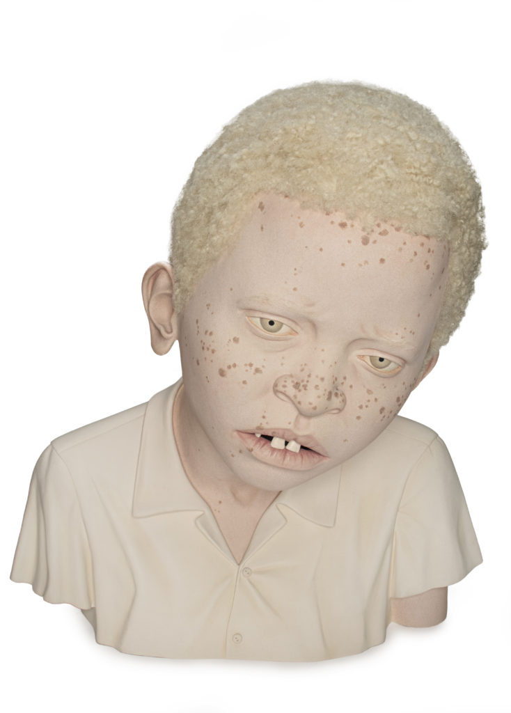 AFRICAN CHILD WITH ALBINISM 1 | 29514